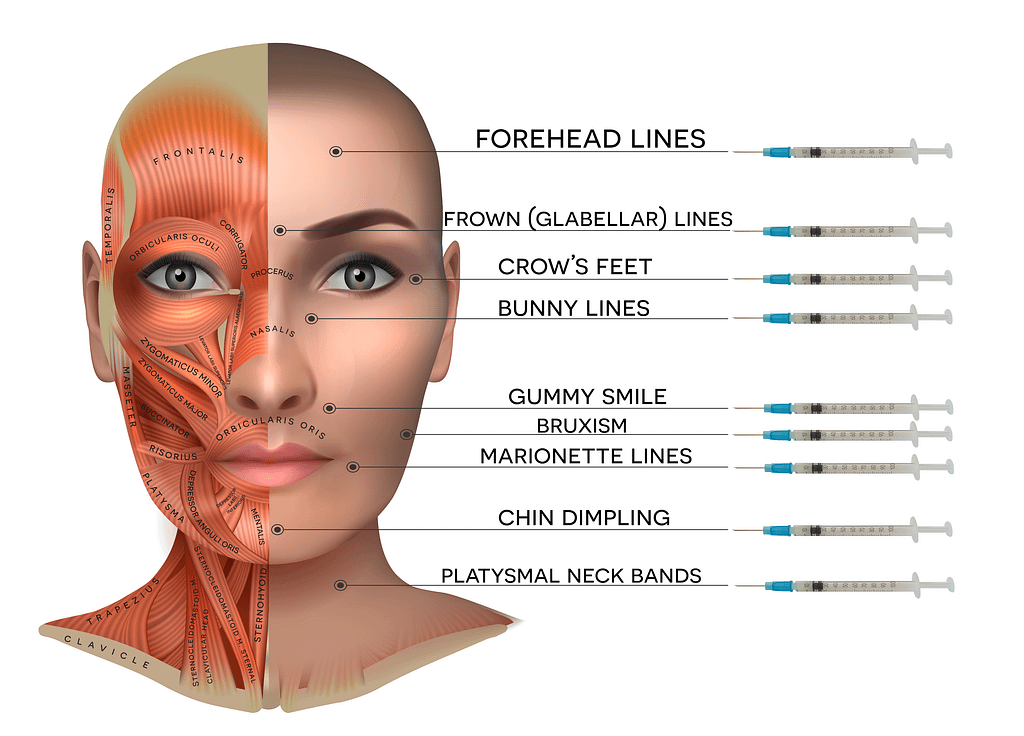 botox and filler treatment areas