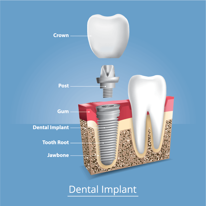 Periodontics Dental Implants East Coast Dental Design